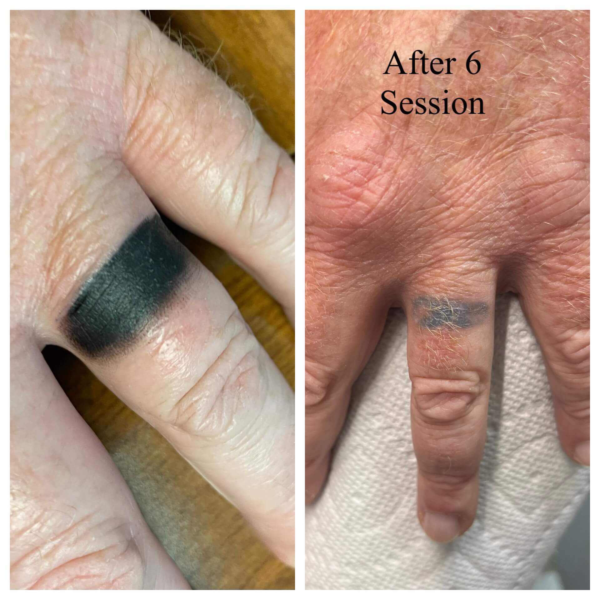  Manatee County Tattoo Removal using Mediyag treatment