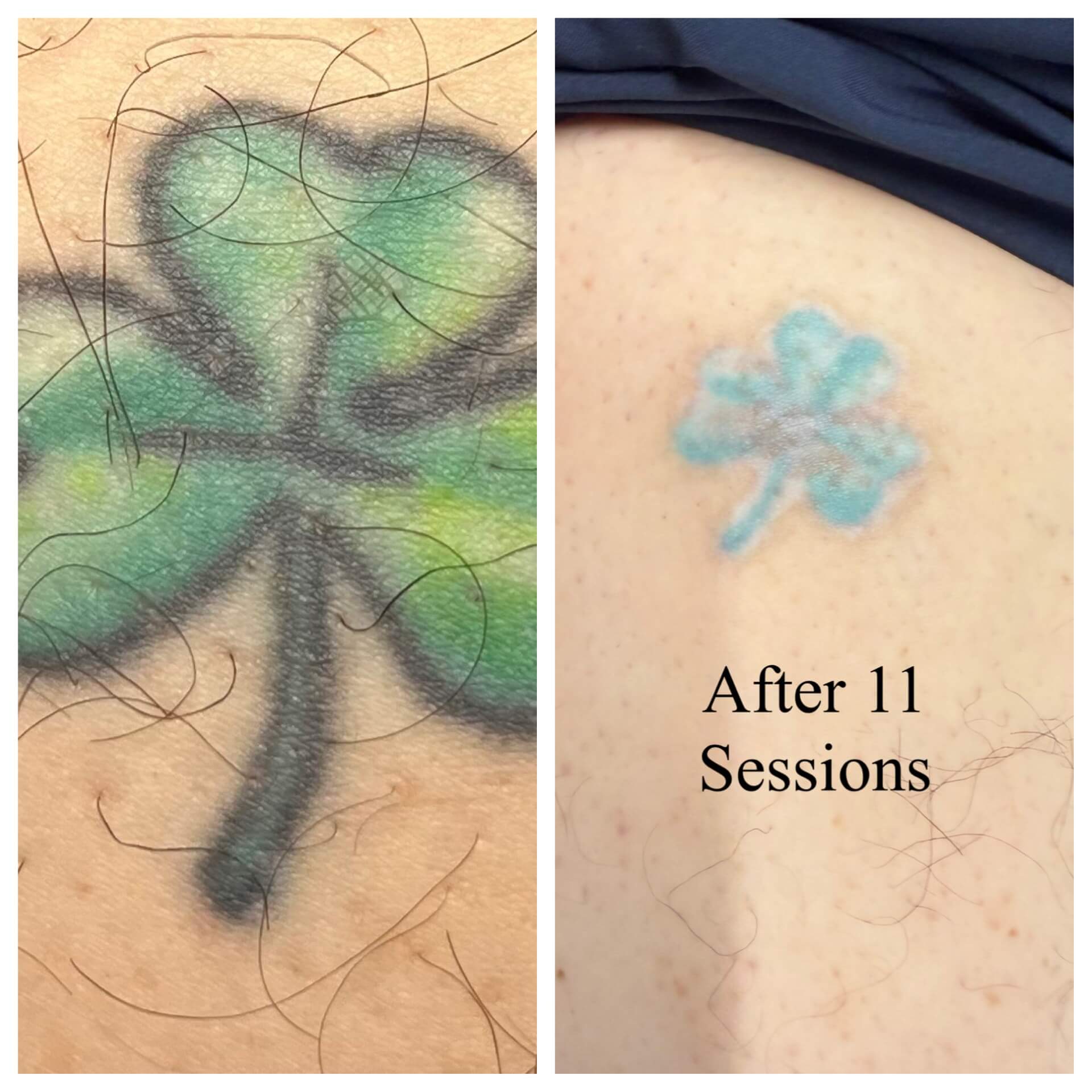Tattoo removal services serving Tampa Bay Area