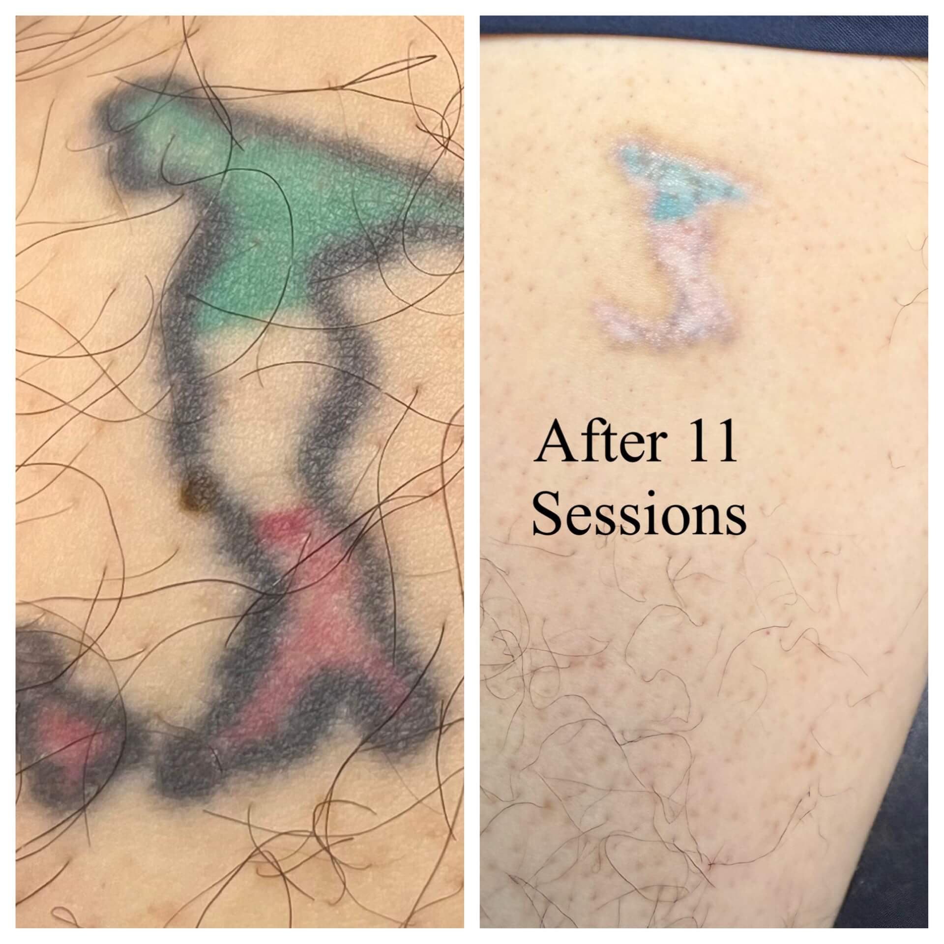 Almost Painless tattoo removal