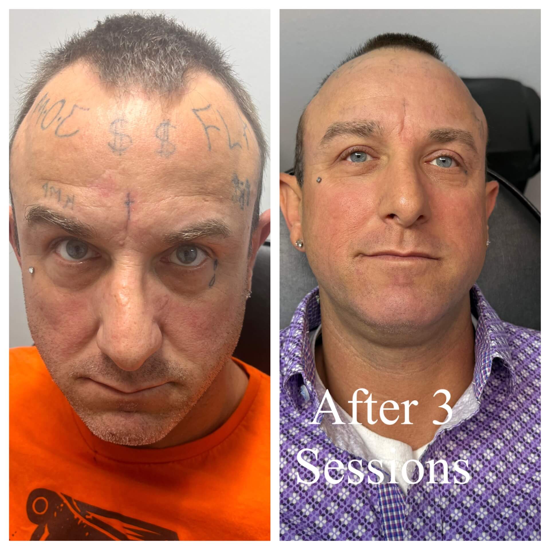  Experienced tattoo removal by Registered Nurse